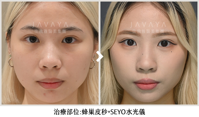 SEYO水光儀+蜂巢皮秒 Before/After